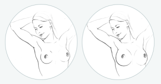 Vorher/Nachher: Es sind verschiedene Verfahren möglich, z.B. die Brustvergrößerung mit Implantat oder Eigenfett.