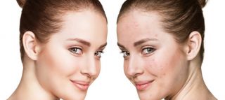 laser epilation hannover Soft Skin Hannover | Laser Haarentfernung | Kryolipolyse | Akne